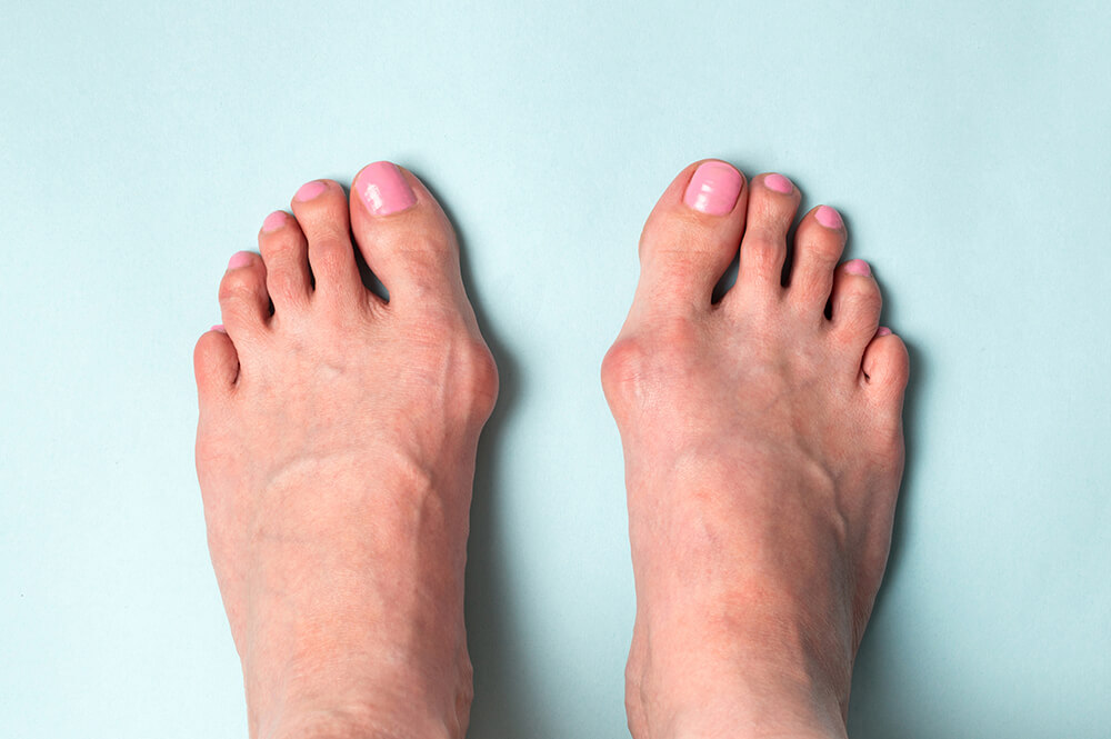 إبهام القدم الأروح - Hallux valgus (Bunion)